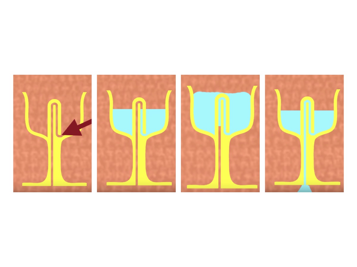 Four coloured section diagrams of a needle patch on skin